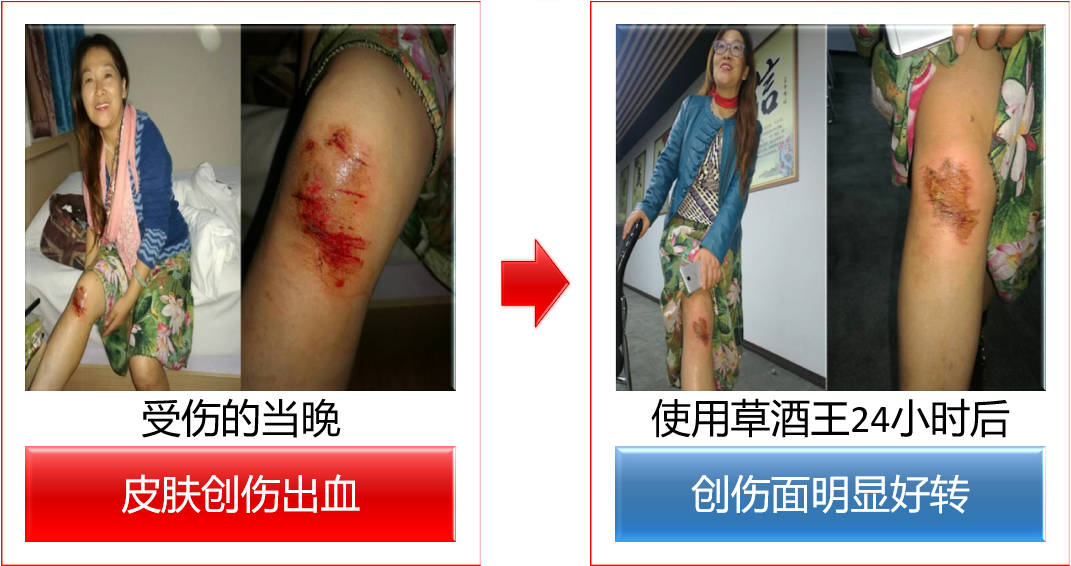 受伤出血 vs 使用草酒王24小时后