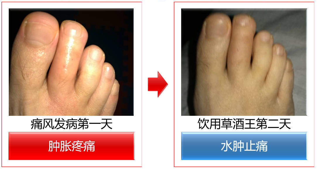 痛风发病第一天 vs 饮用草酒王第二天